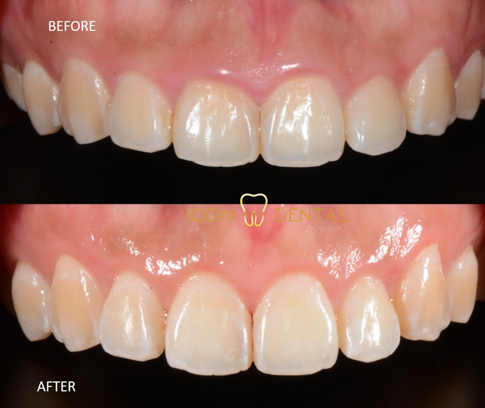 Icon Dental Kepong ( Invisalign Diamond Provider , Veneers, Implant)
